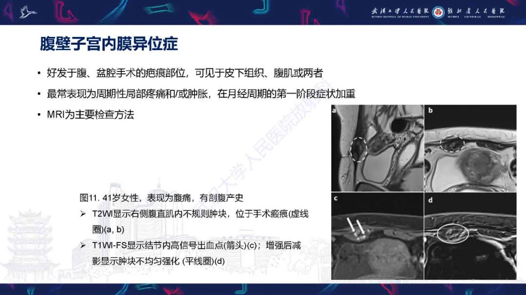 影像PPT - 【PPT】子宫内膜异位症并发症影像诊断-19