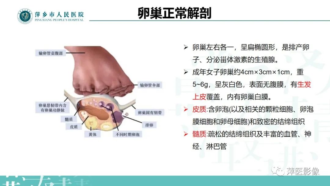 影像PPT - 【PPT】卵巢囊腺瘤诊断与鉴别诊断-4