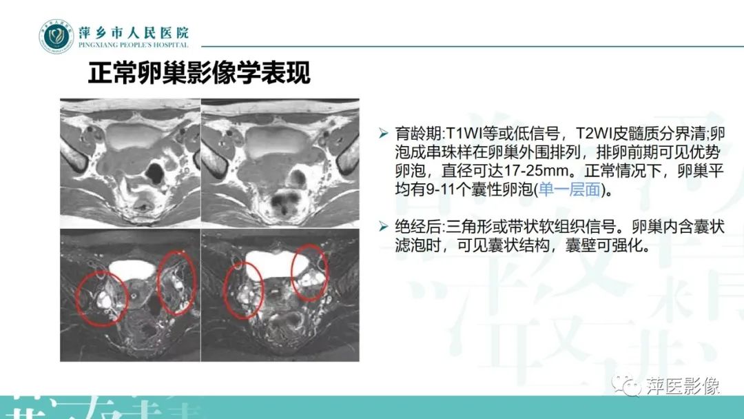 影像PPT - 【PPT】卵巢囊腺瘤诊断与鉴别诊断-7