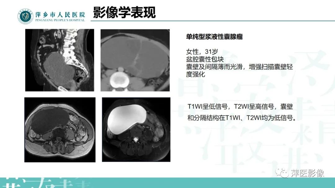 影像PPT - 【PPT】卵巢囊腺瘤诊断与鉴别诊断-13