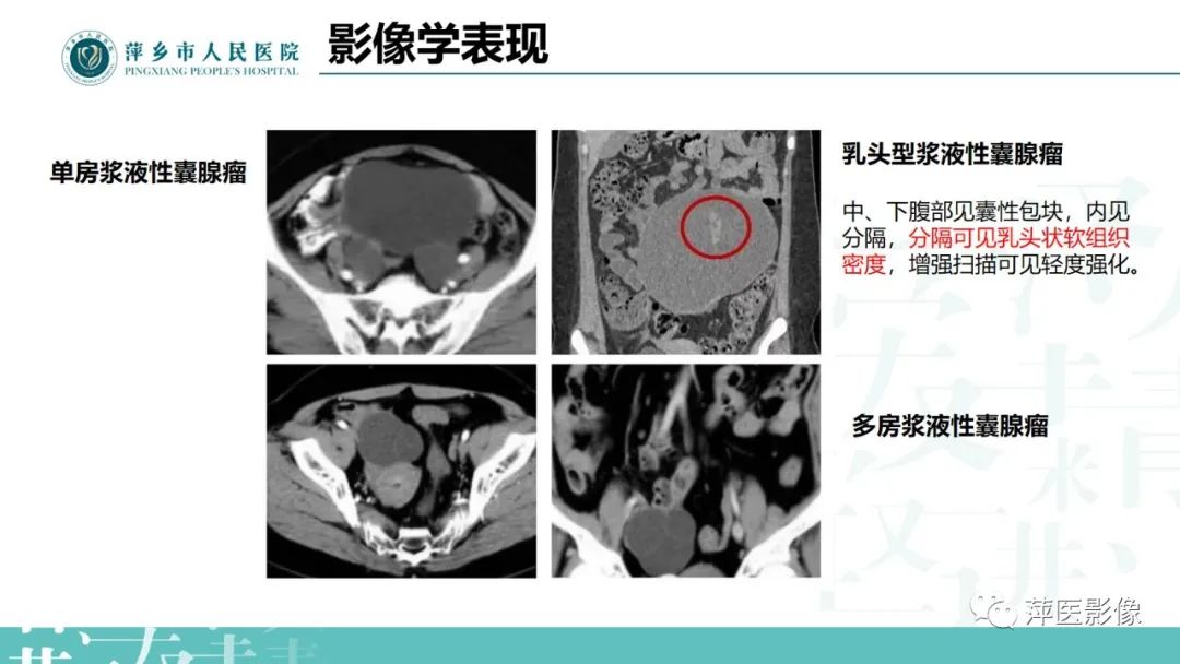 影像PPT - 【PPT】卵巢囊腺瘤诊断与鉴别诊断-14