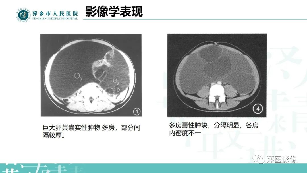 影像PPT - 【PPT】卵巢囊腺瘤诊断与鉴别诊断-16