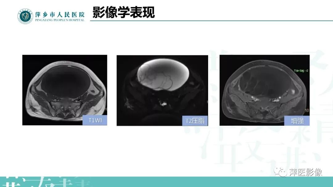 影像PPT - 【PPT】卵巢囊腺瘤诊断与鉴别诊断-17