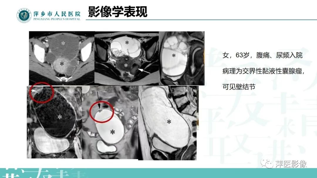 影像PPT - 【PPT】卵巢囊腺瘤诊断与鉴别诊断-18