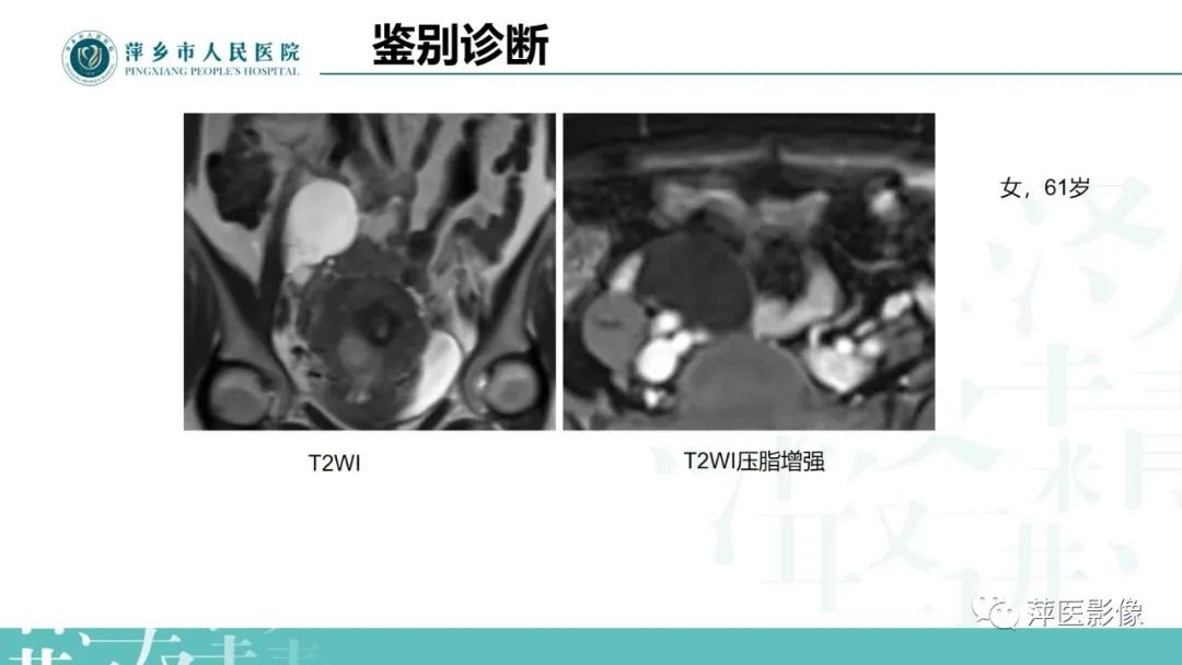 影像PPT - 【PPT】卵巢囊腺瘤诊断与鉴别诊断-23