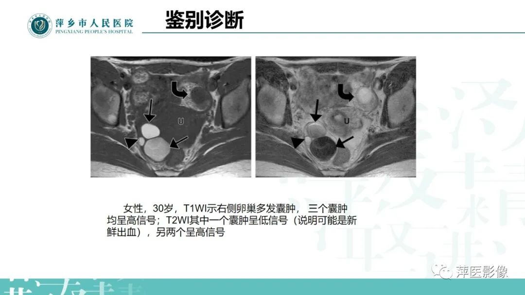 影像PPT - 【PPT】卵巢囊腺瘤诊断与鉴别诊断-25