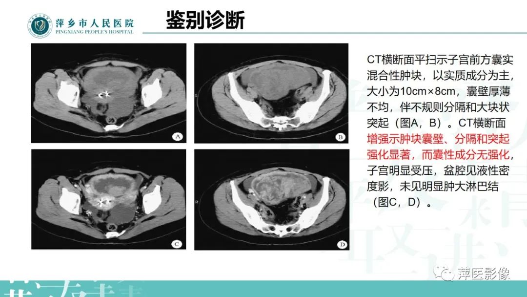 影像PPT - 【PPT】卵巢囊腺瘤诊断与鉴别诊断-28