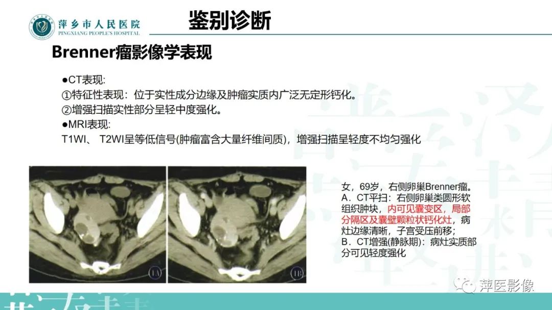 影像PPT - 【PPT】卵巢囊腺瘤诊断与鉴别诊断-30