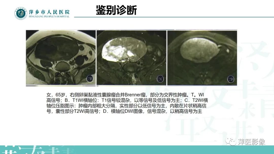 影像PPT - 【PPT】卵巢囊腺瘤诊断与鉴别诊断-31