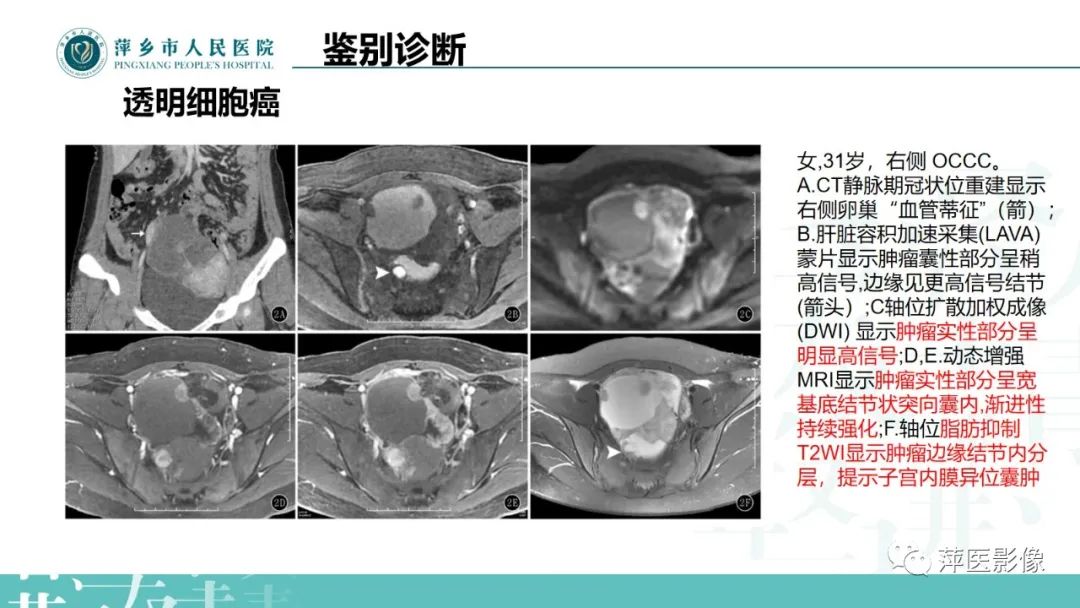 影像PPT - 【PPT】卵巢囊腺瘤诊断与鉴别诊断-34