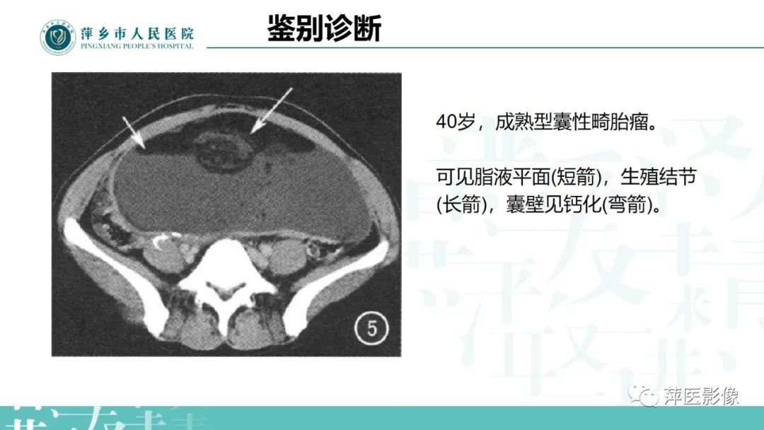 影像PPT - 【PPT】卵巢囊腺瘤诊断与鉴别诊断-37