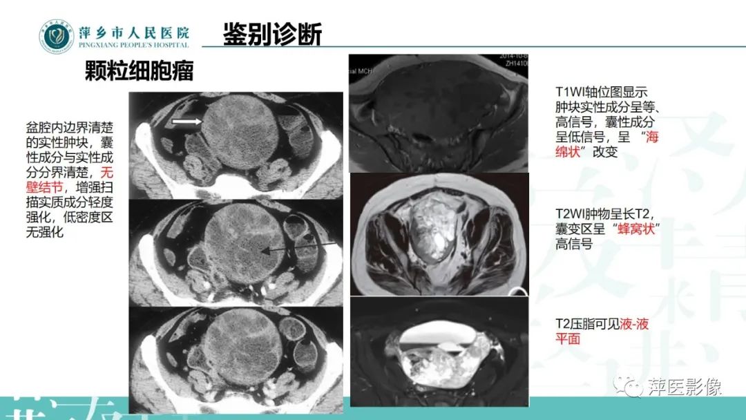 影像PPT - 【PPT】卵巢囊腺瘤诊断与鉴别诊断-39