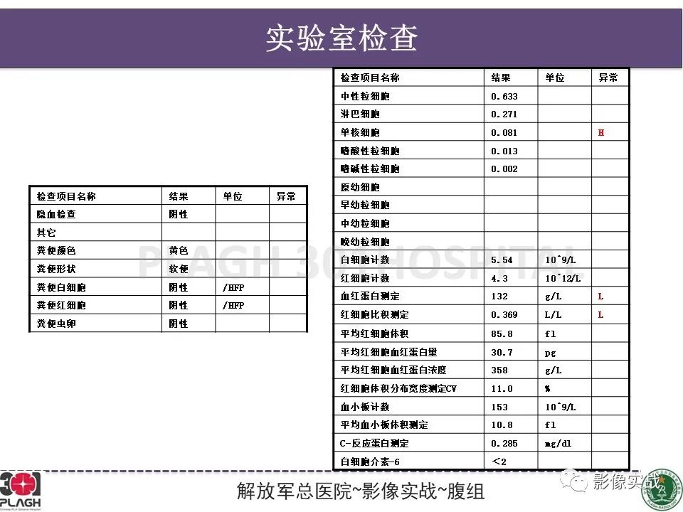 影像PPT - 【病例】腹膜后神经鞘瘤1例CT及MR影像-3