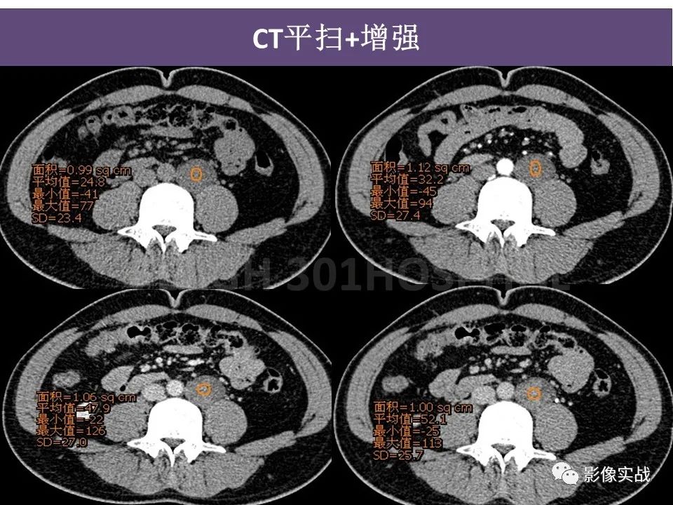 影像PPT - 【病例】腹膜后神经鞘瘤1例CT及MR影像-5