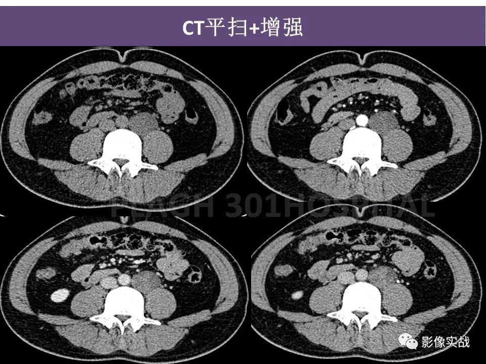 影像PPT - 【病例】腹膜后神经鞘瘤1例CT及MR影像-4