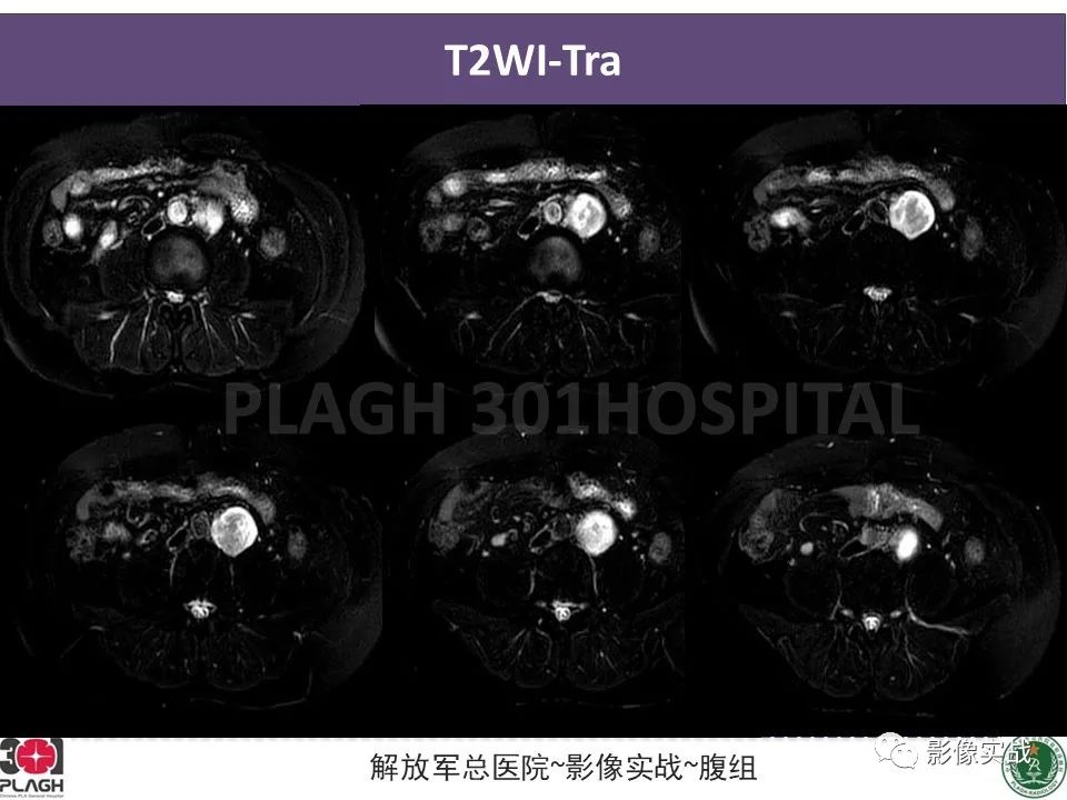 影像PPT - 【病例】腹膜后神经鞘瘤1例CT及MR影像-6