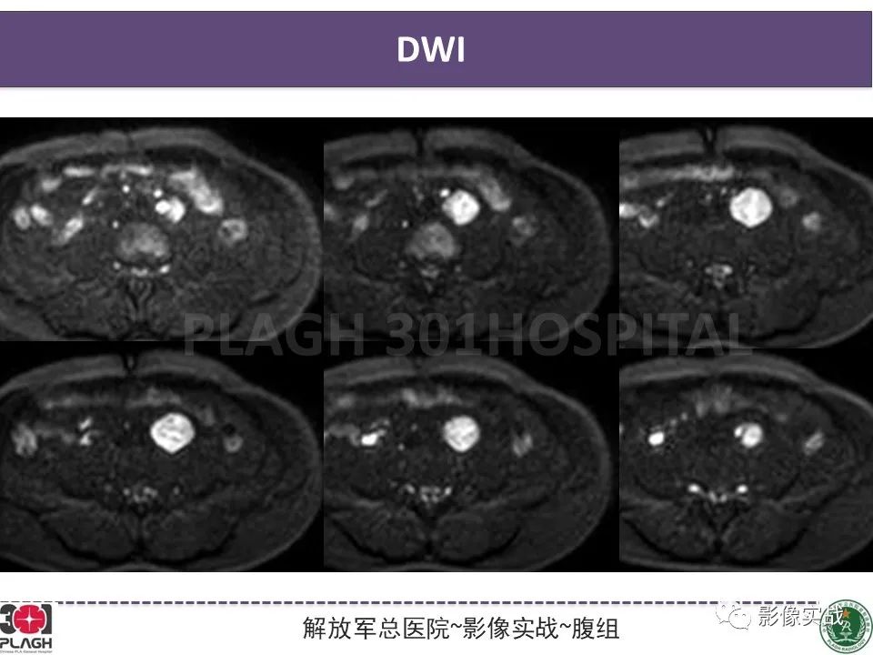 影像PPT - 【病例】腹膜后神经鞘瘤1例CT及MR影像-8