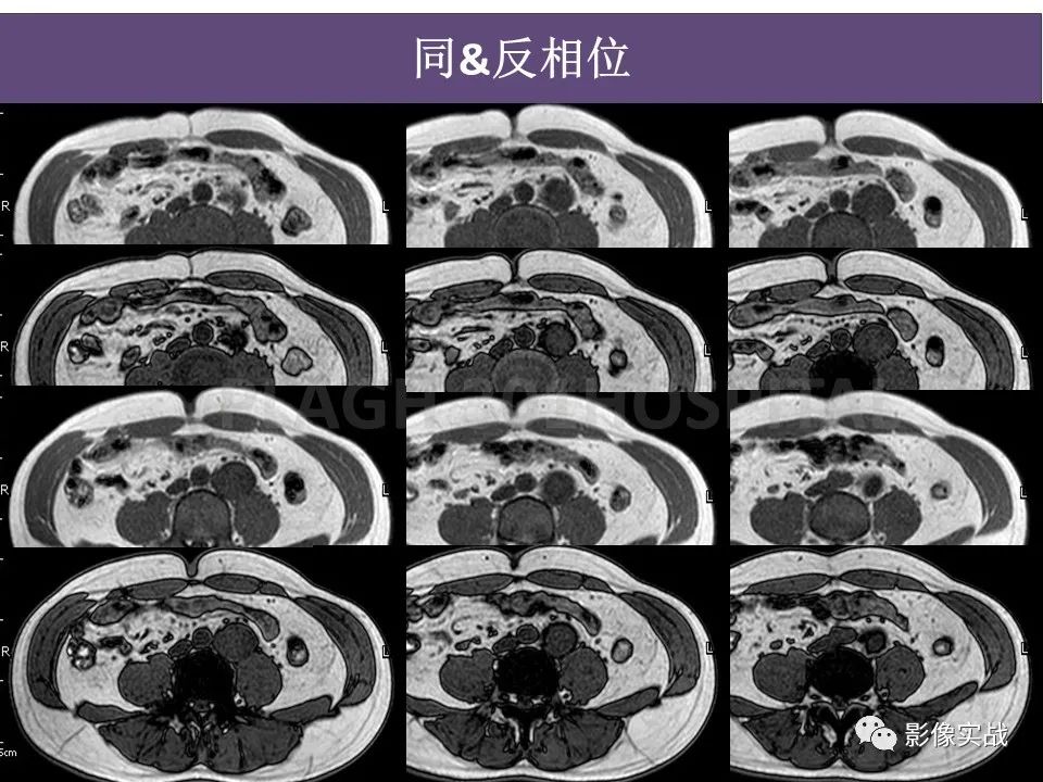 影像PPT - 【病例】腹膜后神经鞘瘤1例CT及MR影像-10