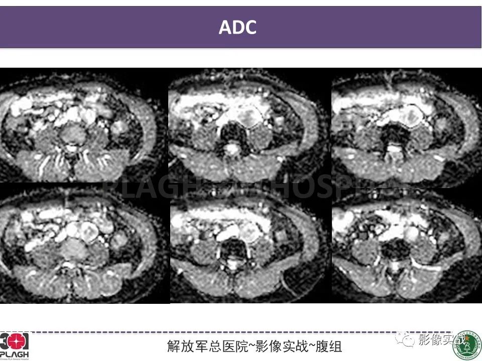 影像PPT - 【病例】腹膜后神经鞘瘤1例CT及MR影像-9