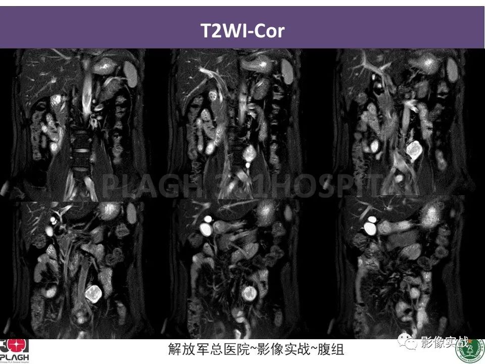 影像PPT - 【病例】腹膜后神经鞘瘤1例CT及MR影像-7