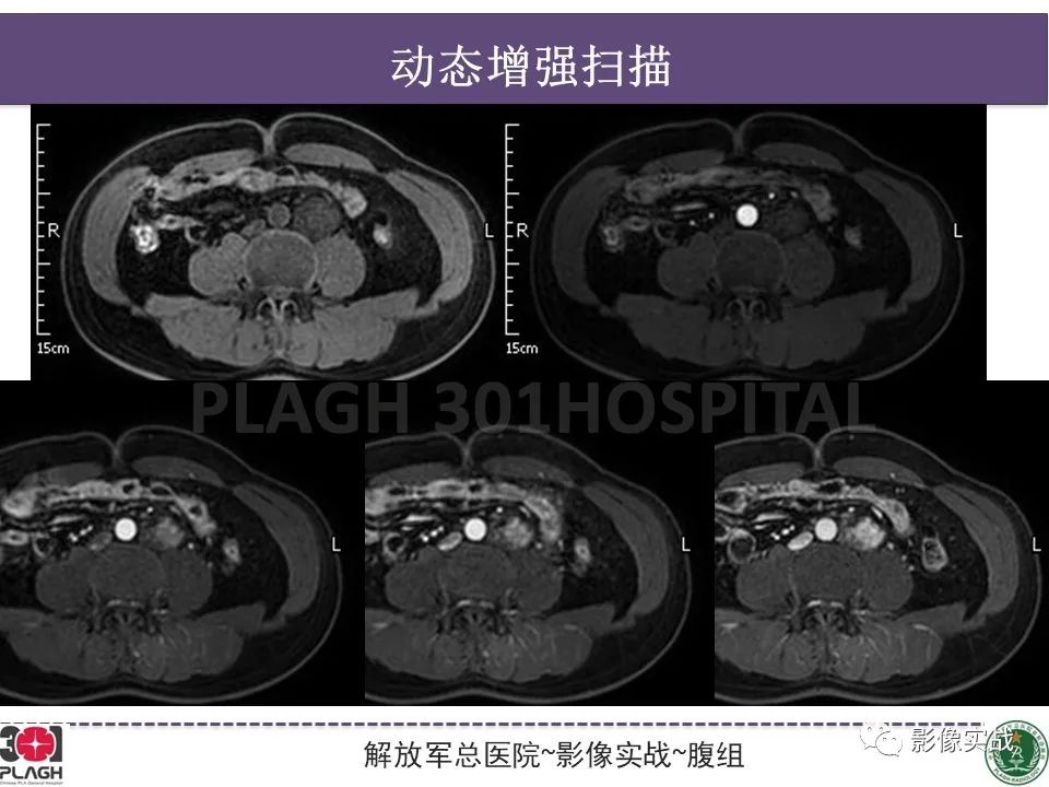 影像PPT - 【病例】腹膜后神经鞘瘤1例CT及MR影像-11