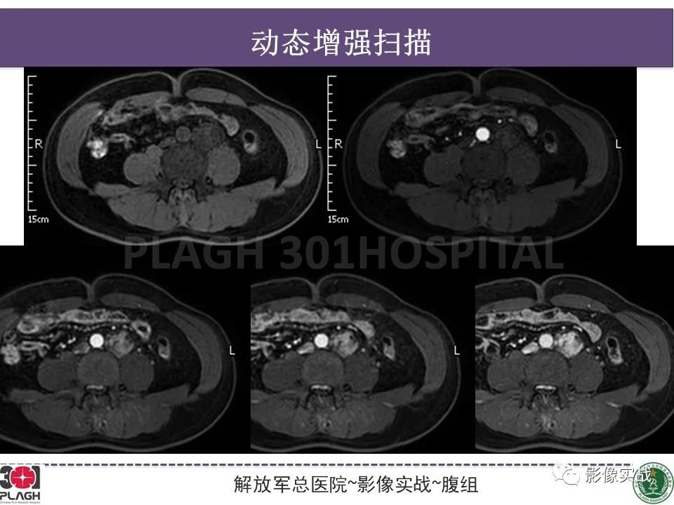 影像PPT - 【病例】腹膜后神经鞘瘤1例CT及MR影像-12