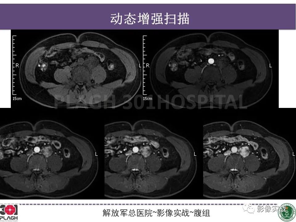 影像PPT - 【病例】腹膜后神经鞘瘤1例CT及MR影像-13