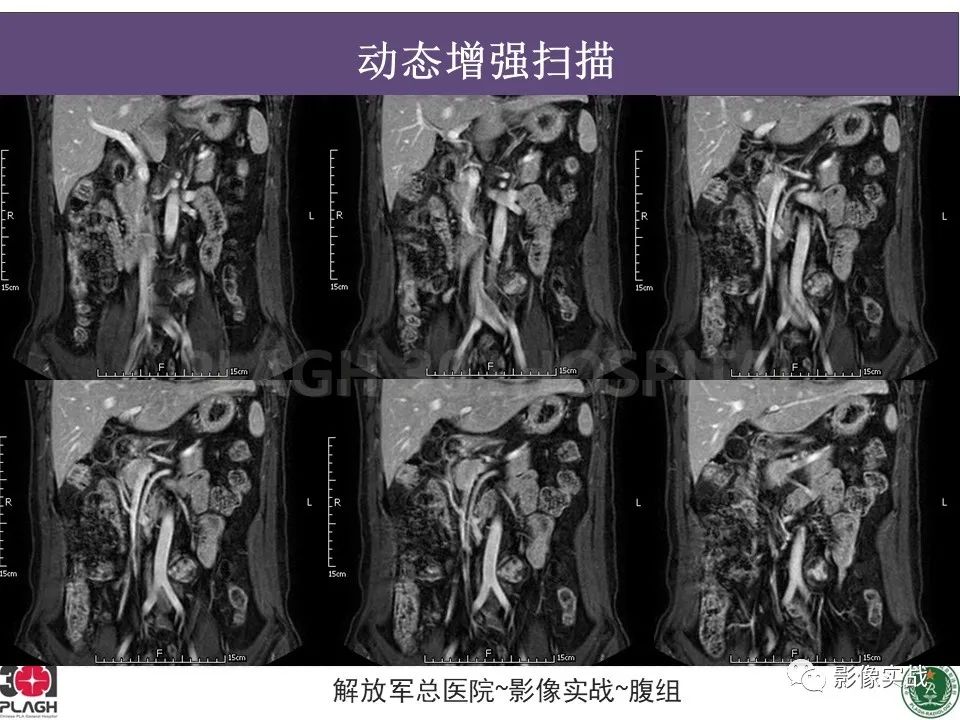影像PPT - 【病例】腹膜后神经鞘瘤1例CT及MR影像-15