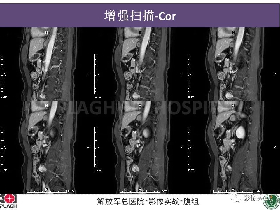 影像PPT - 【病例】腹膜后神经鞘瘤1例CT及MR影像-16
