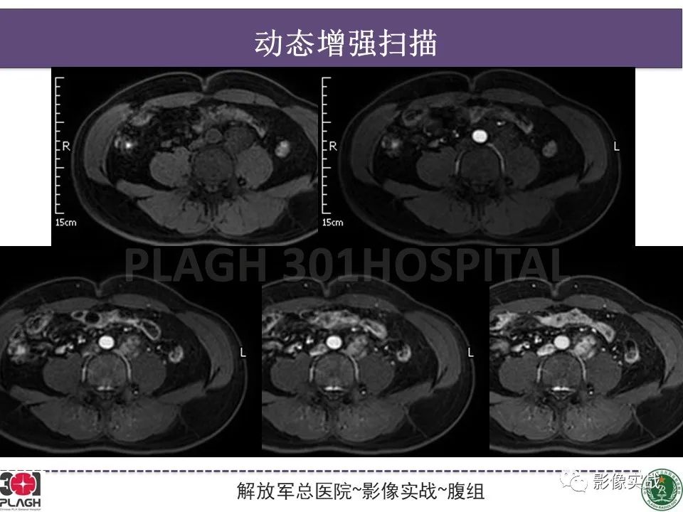 影像PPT - 【病例】腹膜后神经鞘瘤1例CT及MR影像-14