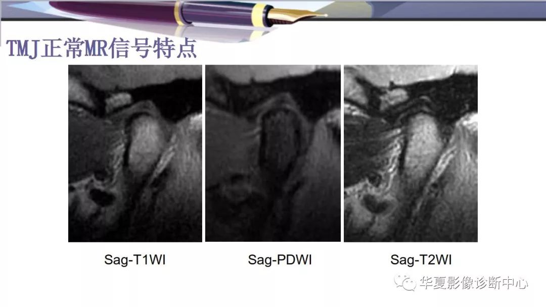 影像PPT - 颞下颌关节紊乱病的磁共振表现-5