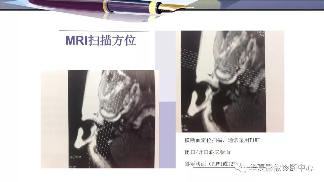 影像PPT - 颞下颌关节紊乱病的磁共振表现-4