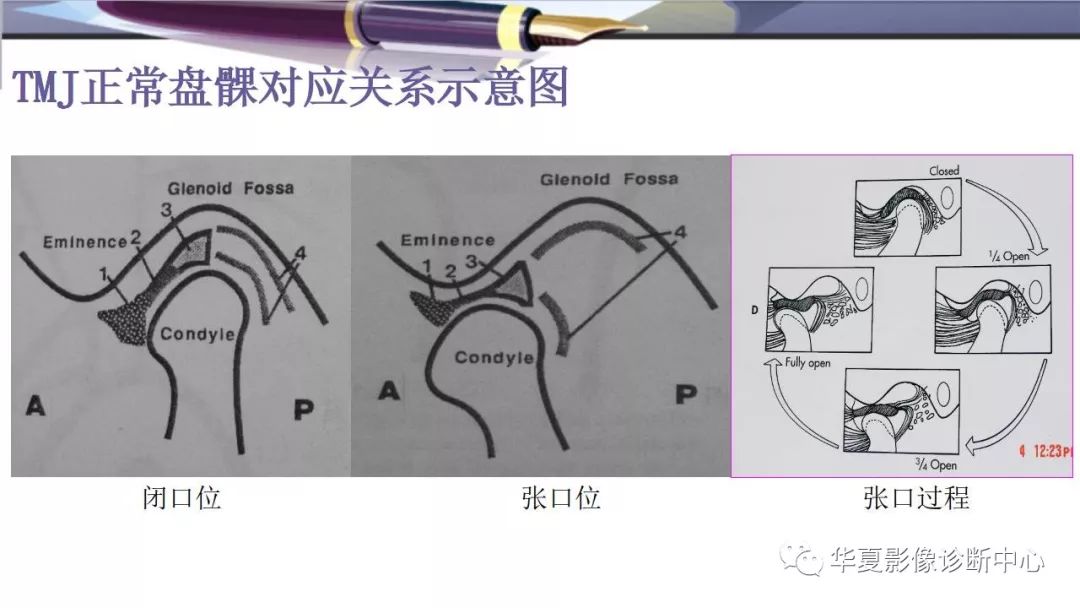 影像PPT - 颞下颌关节紊乱病的磁共振表现-6