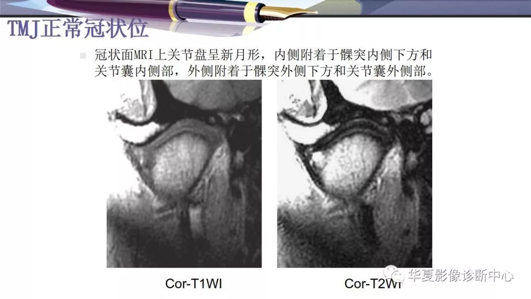 影像PPT - 颞下颌关节紊乱病的磁共振表现-8