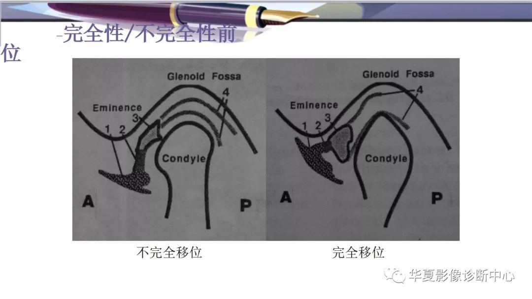 影像PPT - 颞下颌关节紊乱病的磁共振表现-11