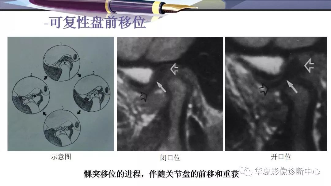 影像PPT - 颞下颌关节紊乱病的磁共振表现-12