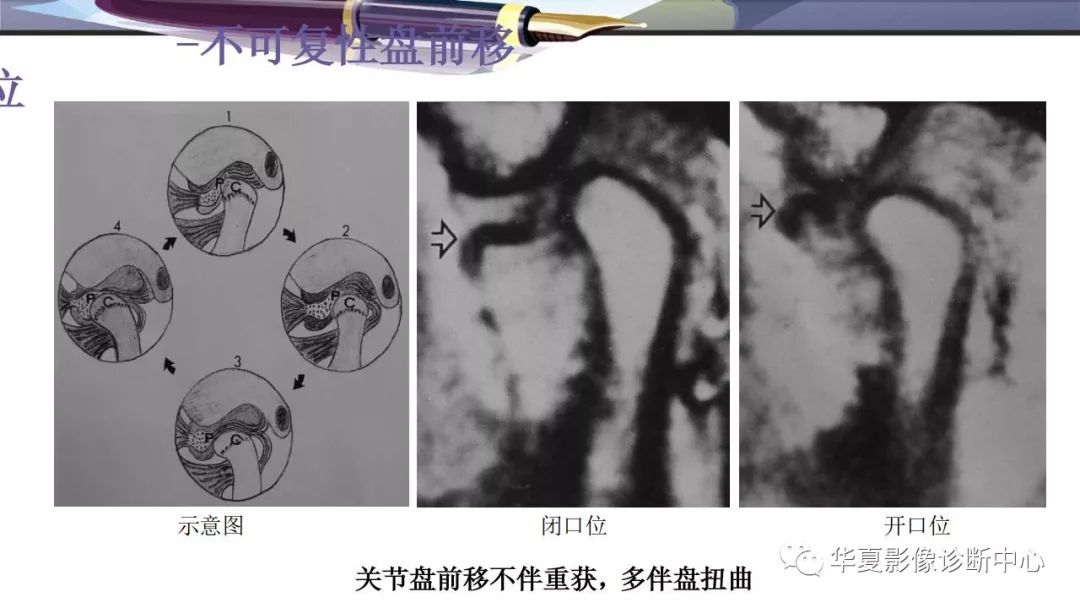 影像PPT - 颞下颌关节紊乱病的磁共振表现-13