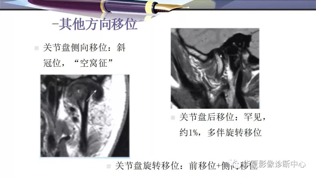 影像PPT - 颞下颌关节紊乱病的磁共振表现-14