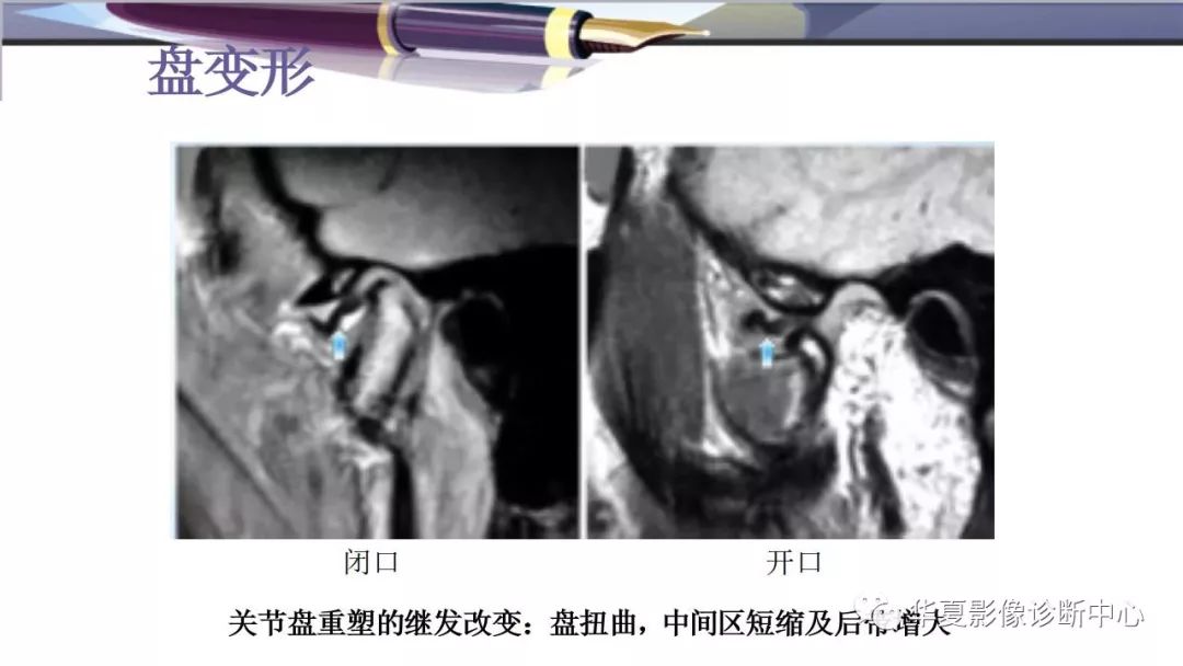 影像PPT - 颞下颌关节紊乱病的磁共振表现-15