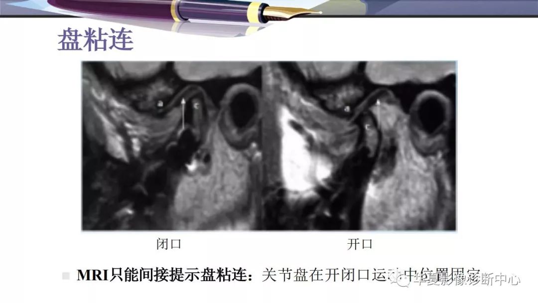 影像PPT - 颞下颌关节紊乱病的磁共振表现-17