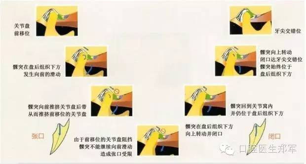 影像PPT - 颞下颌关节紊乱病的磁共振表现-20
