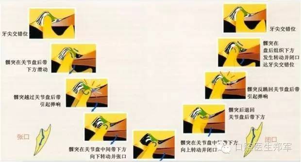 影像PPT - 颞下颌关节紊乱病的磁共振表现-1