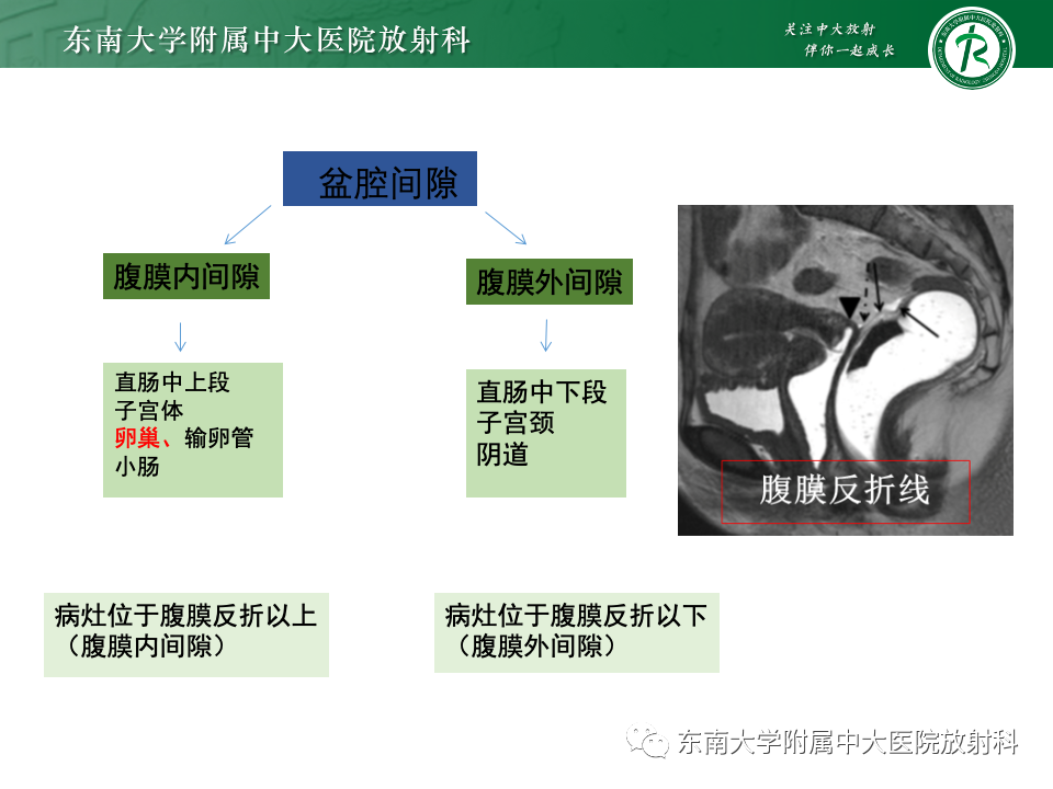 影像PPT - 【PPT】卵巢无性细胞瘤-9