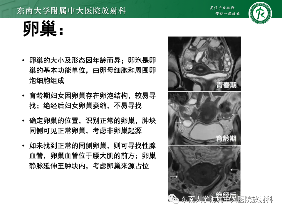 影像PPT - 【PPT】卵巢无性细胞瘤-11