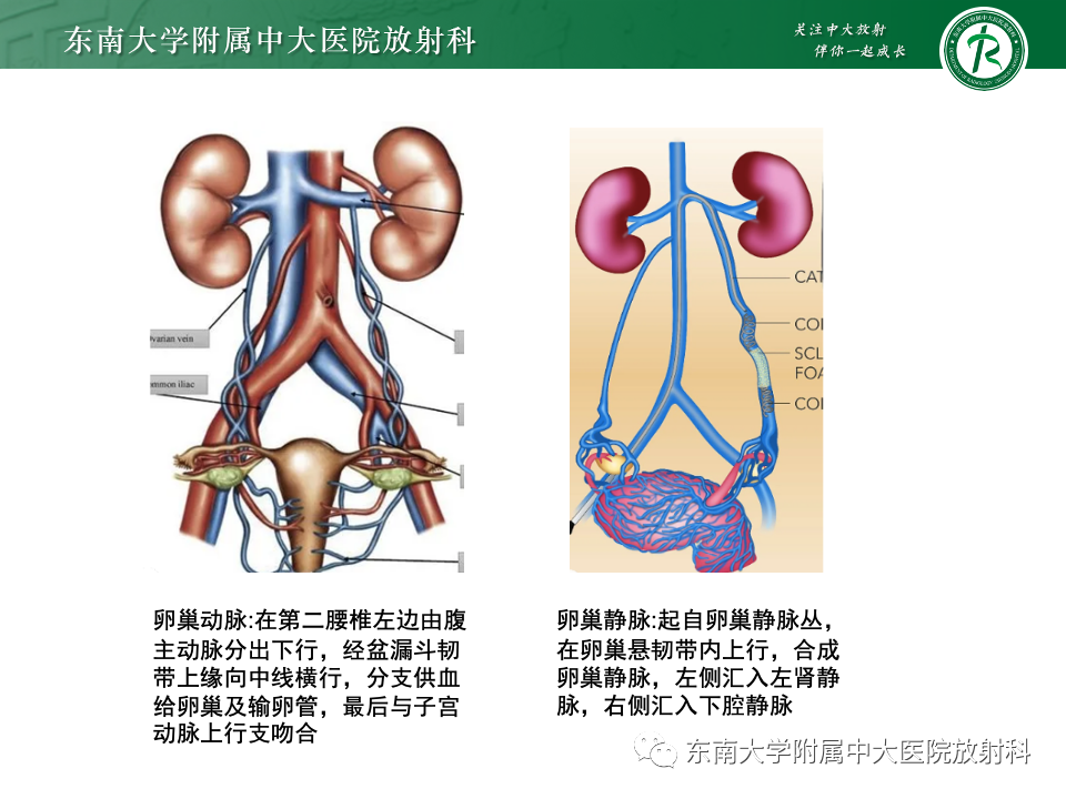 影像PPT - 【PPT】卵巢无性细胞瘤-12