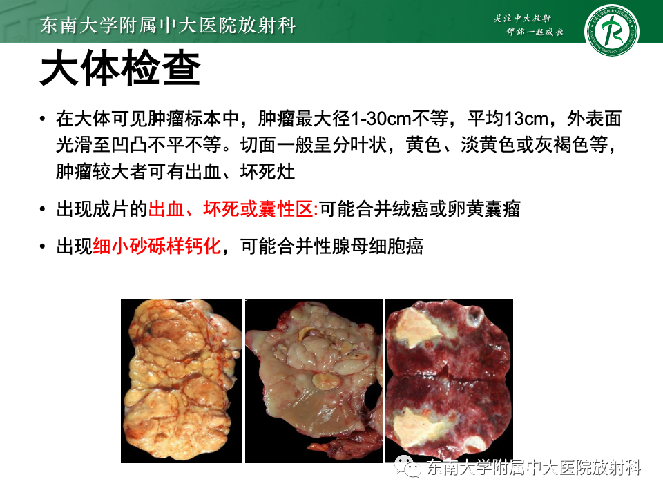 影像PPT - 【PPT】卵巢无性细胞瘤-16
