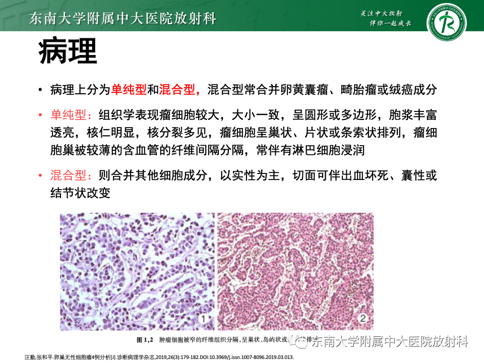 影像PPT - 【PPT】卵巢无性细胞瘤-17