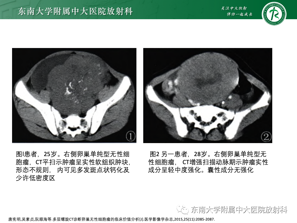 影像PPT - 【PPT】卵巢无性细胞瘤-19