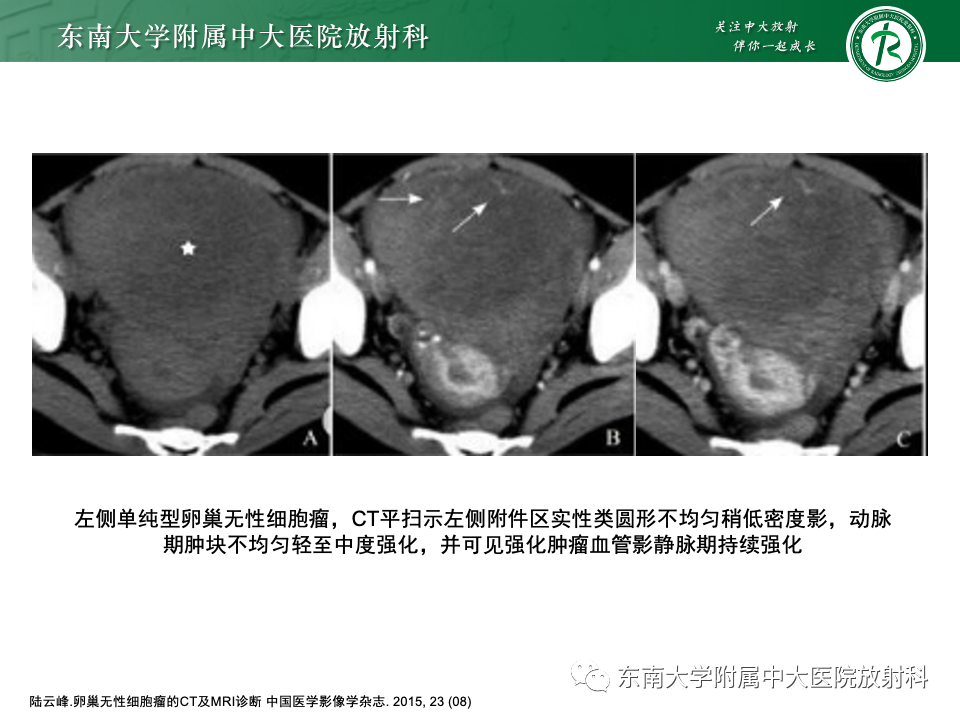影像PPT - 【PPT】卵巢无性细胞瘤-20