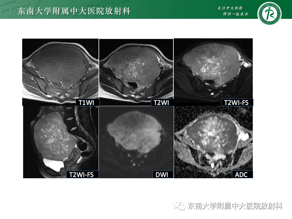 影像PPT - 【PPT】卵巢无性细胞瘤-23